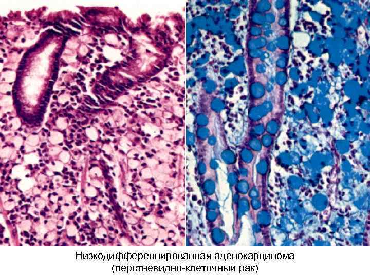Низкодифференцированная аденокарцинома (перстневидно-клеточный рак) 