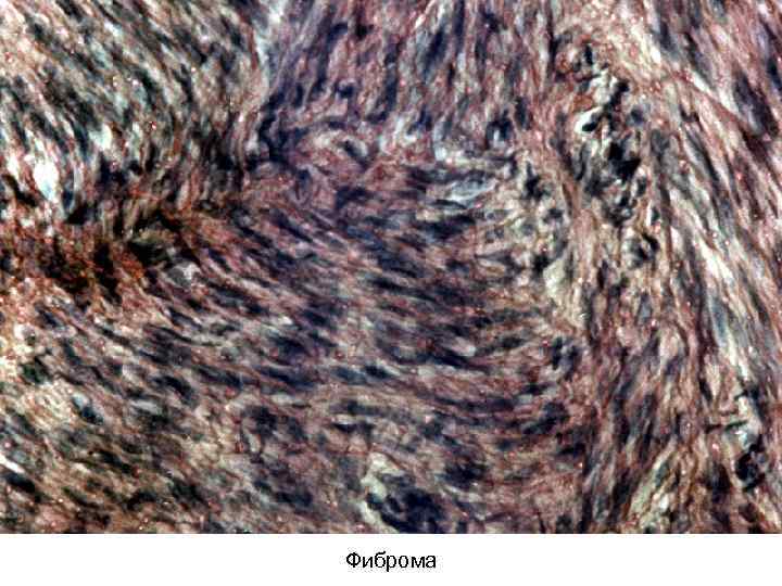 Фиброма 