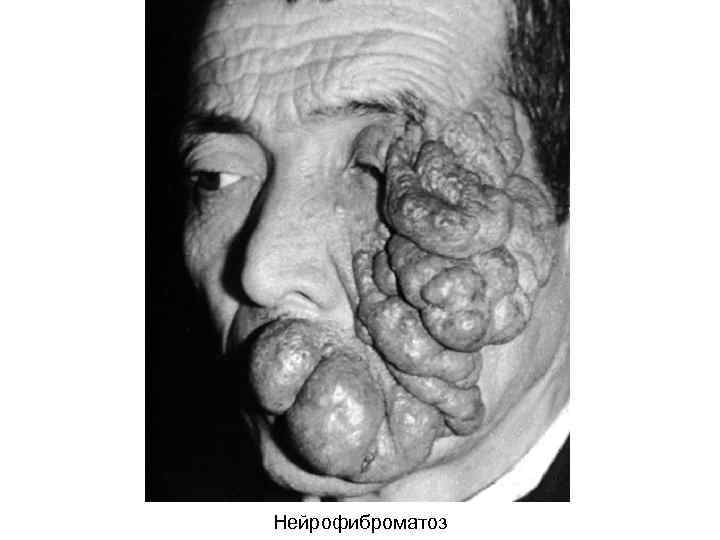 Нейрофиброматоз 