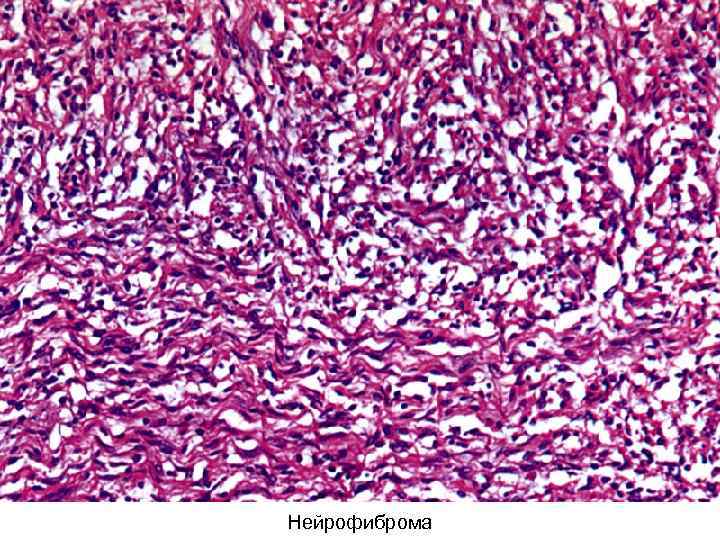 Нейрофиброма 