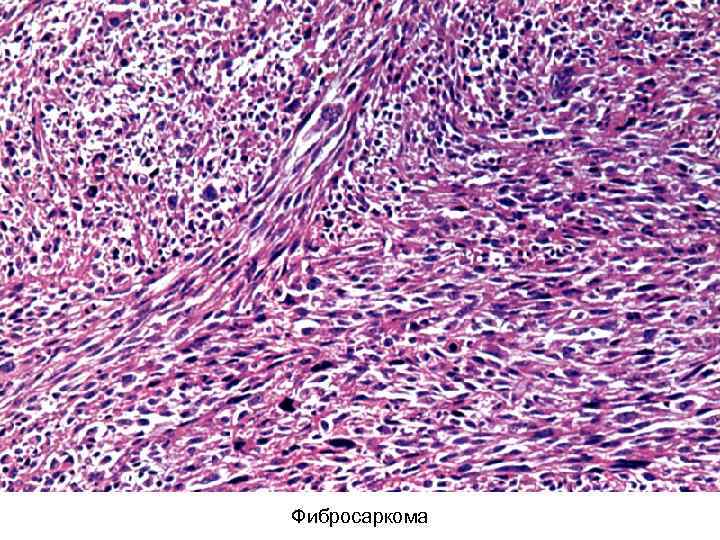 Фибросаркома 
