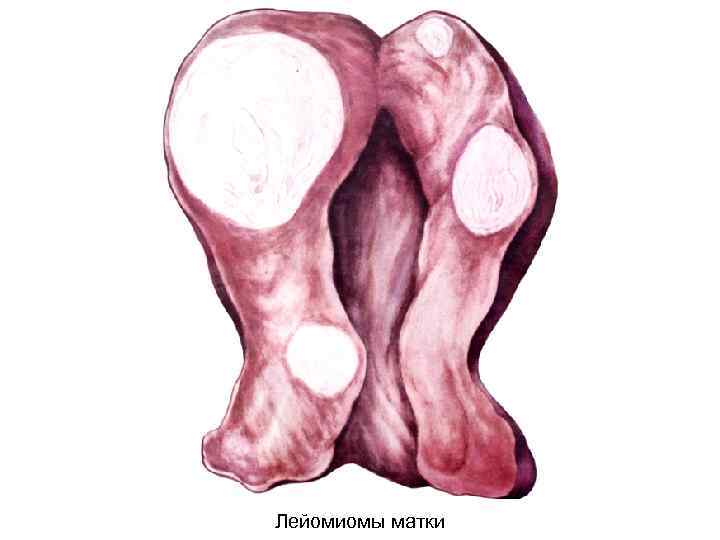 Лейомиомы матки 