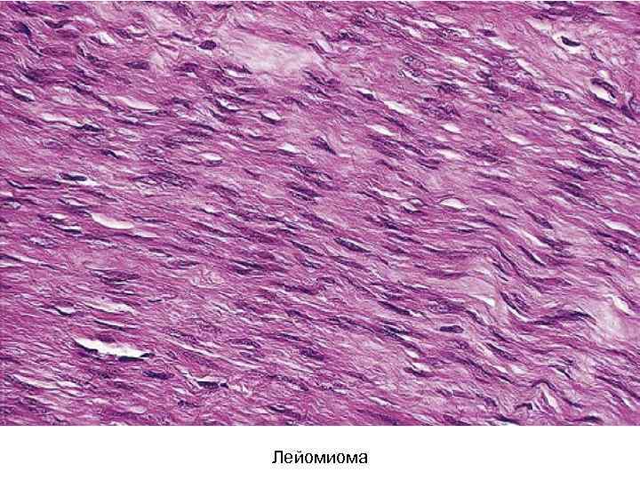 Лейомиома 