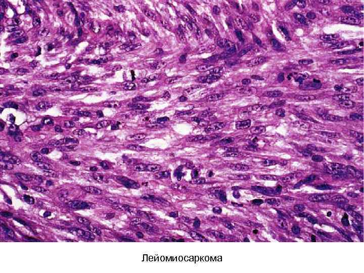 Лейомиосаркома 