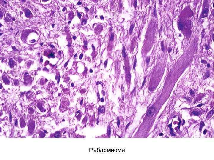 Рабдомиома 