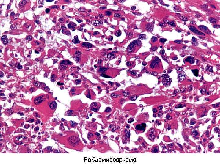 Рабдомиосаркома 