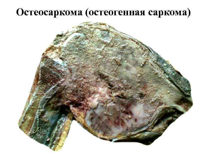 Остеосаркома (остеогенная саркома) 