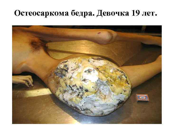 Остеосаркома бедра. Девочка 19 лет. 