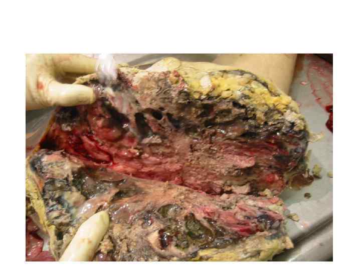 Остеосаркома. 