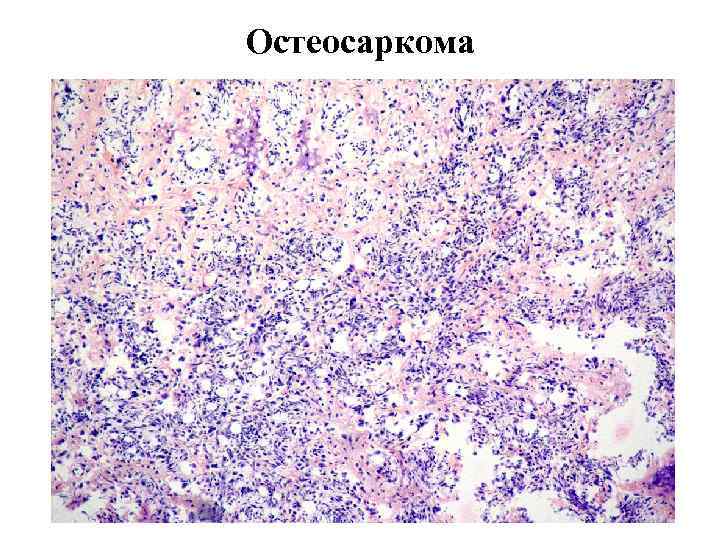 Остеосаркома 