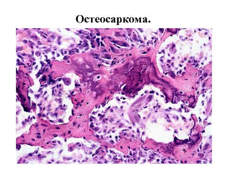 Остеосаркома. 