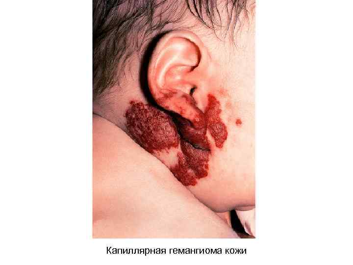 Капиллярная гемангиома кожи 