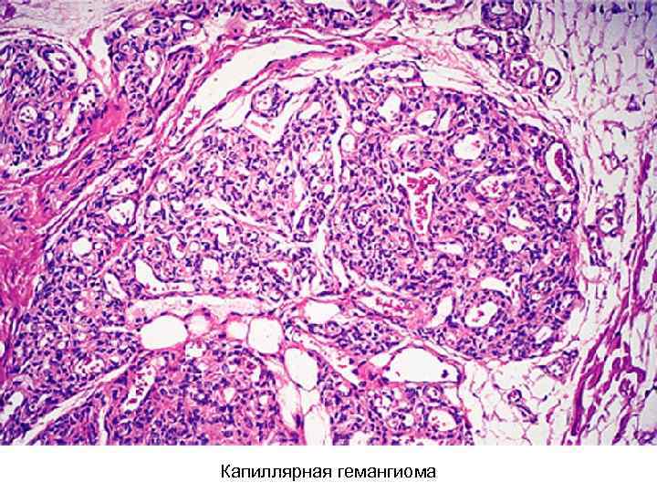 Капиллярная гемангиома 