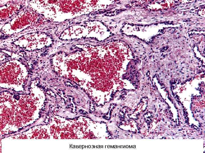 Кавернозная гемангиома 