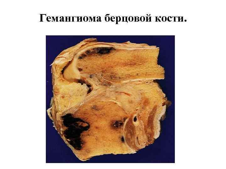 Гемангиома берцовой кости. 