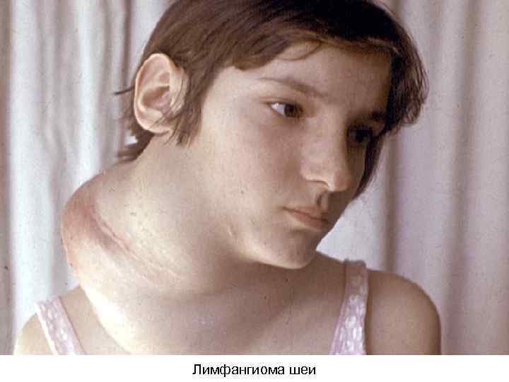 Лимфангиома шеи 