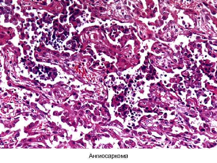 Ангиосаркома 