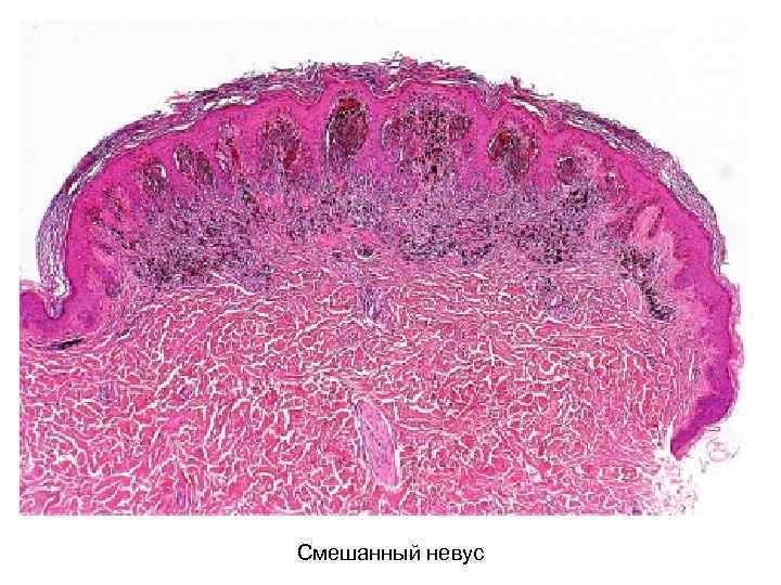 Смешанный невус 