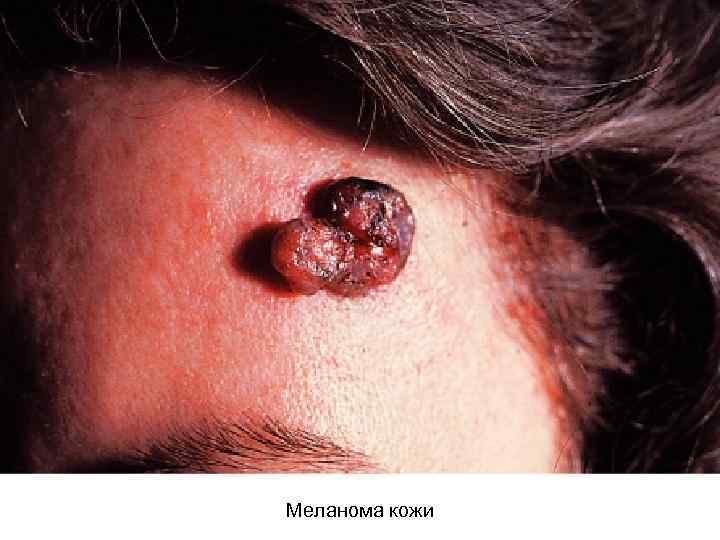 Меланома кожи 