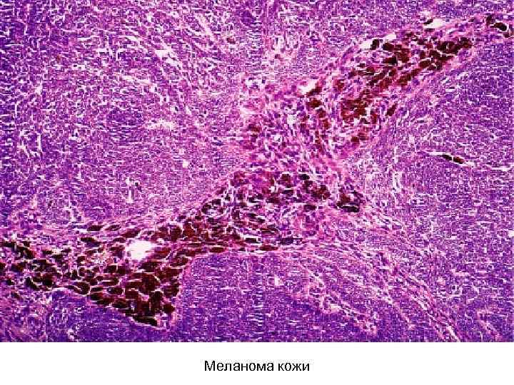 Меланома кожи 