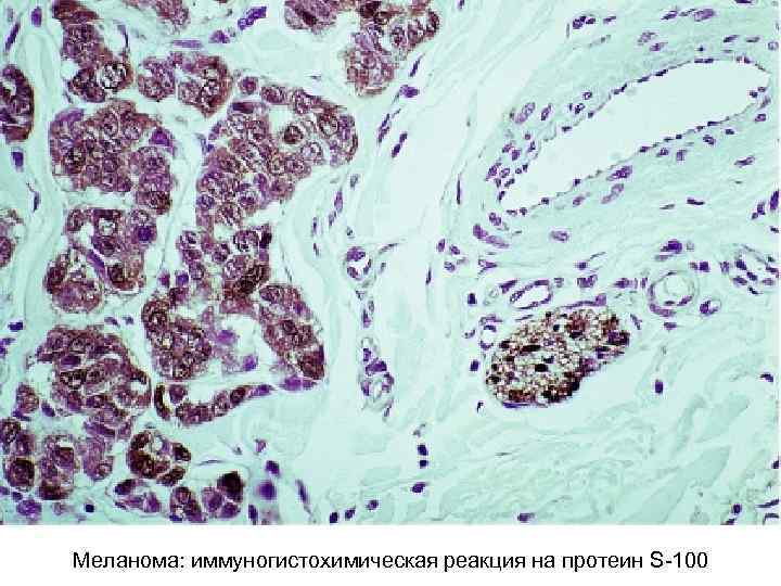Меланома: иммуногистохимическая реакция на протеин S-100 