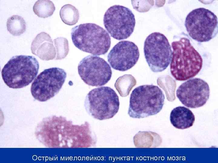 Острый миелолейкоз: пунктат костного мозга 