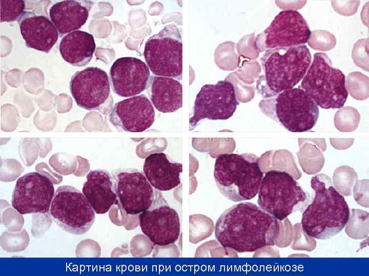 При лимфолейкозе картина крови