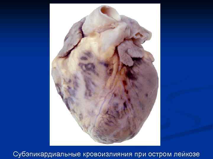 Субэпикардиальные кровоизлияния при остром лейкозе 