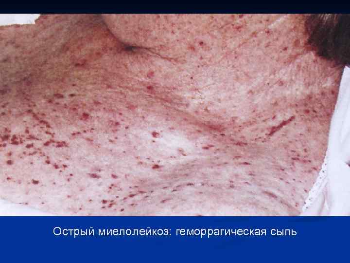 Острый миелолейкоз: геморрагическая сыпь 