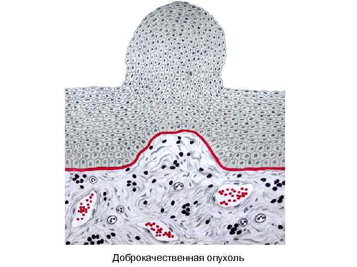Доброкачественная опухоль 