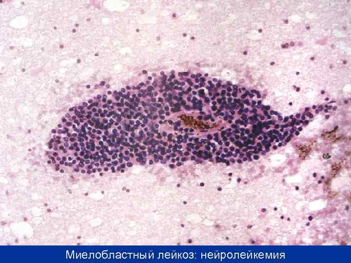 Миелобластный лейкоз: нейролейкемия 