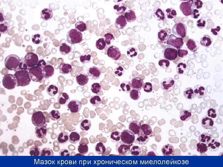 Мазок крови при хроническом миелолейкозе 