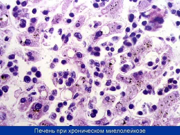 Печень при хроническом миелолейкозе 