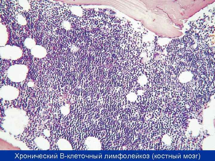 Хронический В-клеточный лимфолейкоз (костный мозг) 
