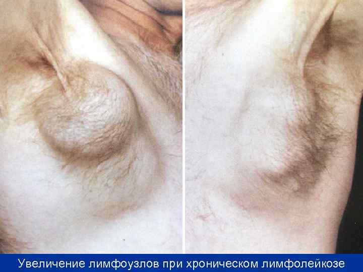 Увеличение лимфоузлов при хроническом лимфолейкозе 