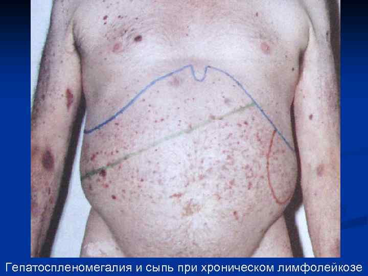 Гепатоспленомегалия и сыпь при хроническом лимфолейкозе 