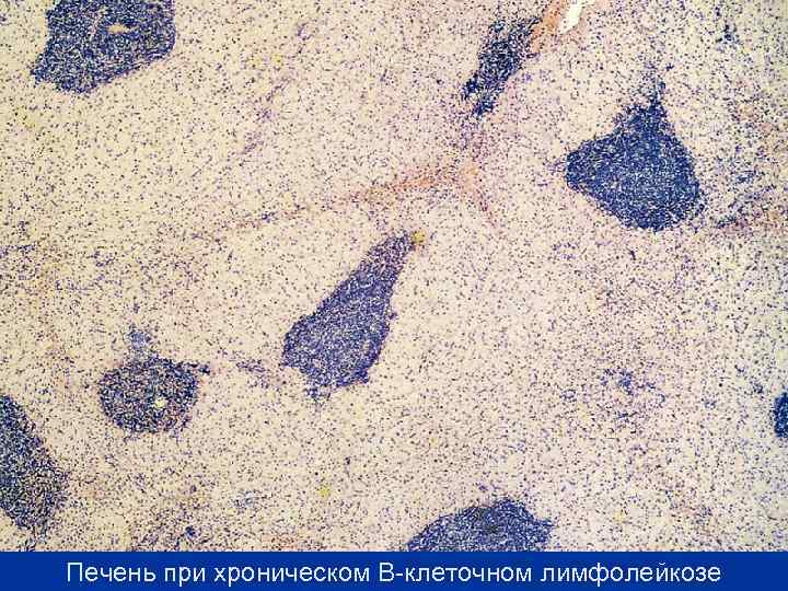 Печень при хроническом В-клеточном лимфолейкозе 