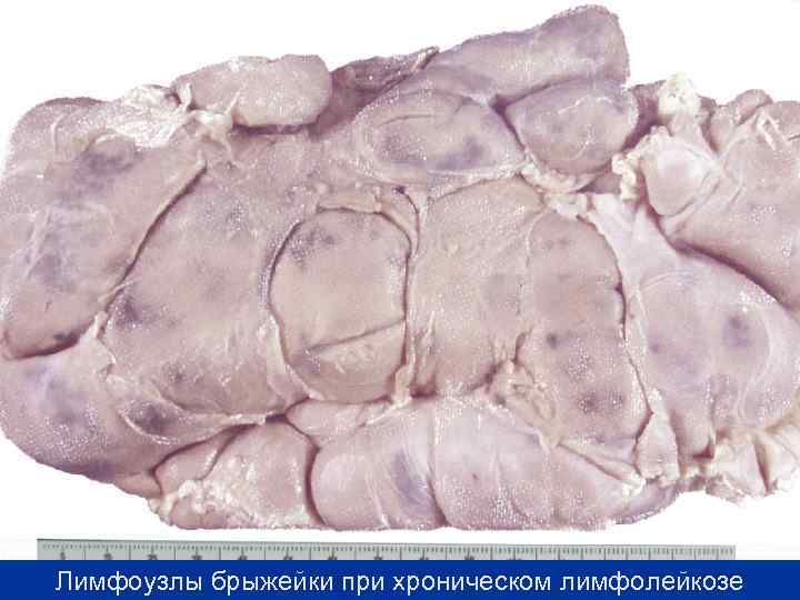 Лимфоузлы брыжейки при хроническом лимфолейкозе 
