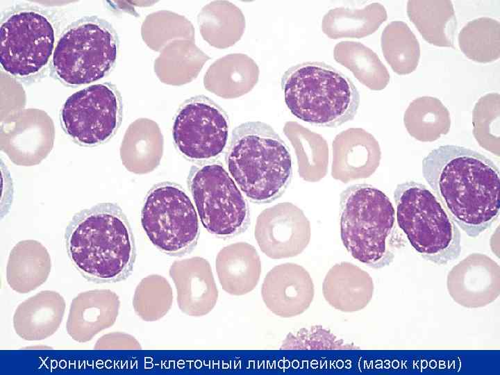 Хронический В-клеточный лимфолейкоз (мазок крови) 