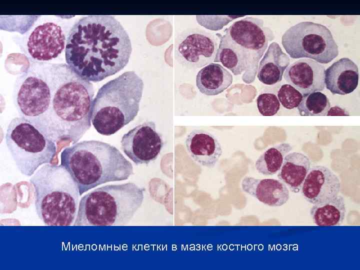 Миеломные клетки в мазке костного мозга 