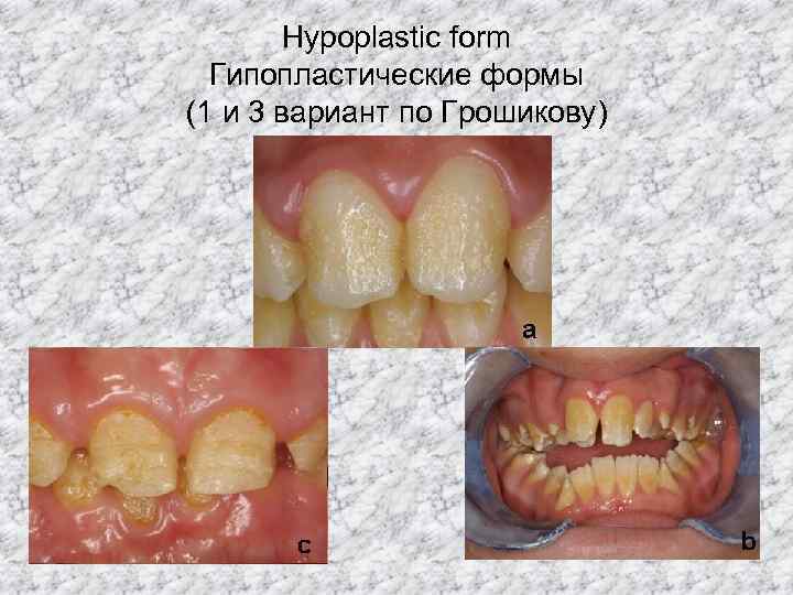   Hypoplastic form  Гипопластические формы (1 и 3 вариант по Грошикову) 