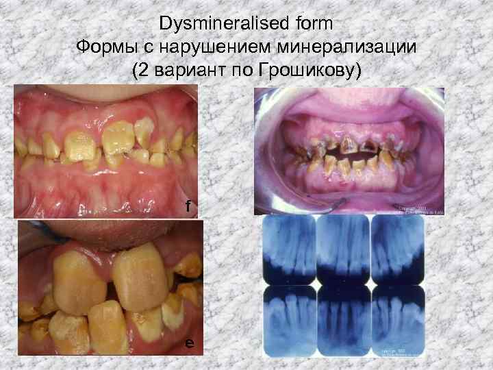   Dysmineralised form Формы с нарушением минерализации (2 вариант по Грошикову) 