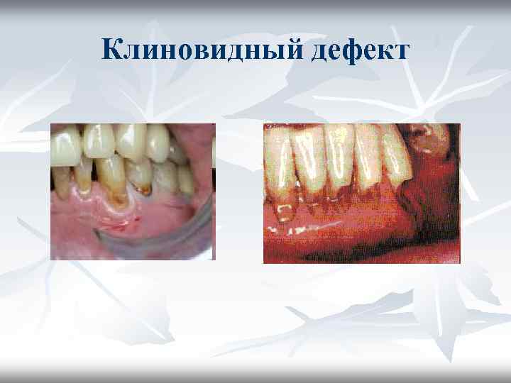 Клиновидный дефект Клиновидный дефект