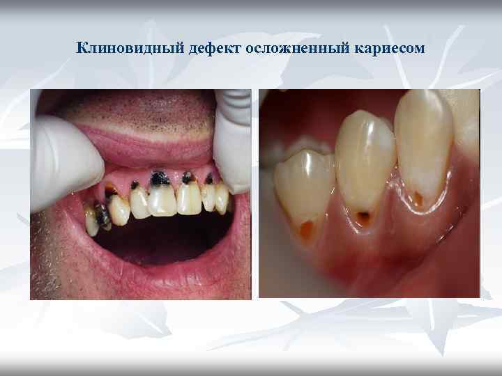 Клиновидный дефект осложненный кариесом Клиновидный дефект осложненный кариесом