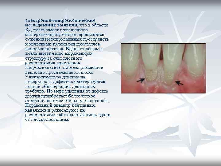 электронно-микроскопические исследования выявили, что в области КД эмаль имеет повышенную минерализацию, которая проявляется сужением электронно-микроскопические исследования выявили, что в области КД эмаль имеет повышенную минерализацию, которая проявляется сужением