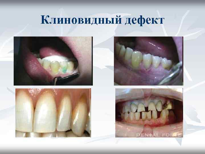 Клиновидный дефект презентация