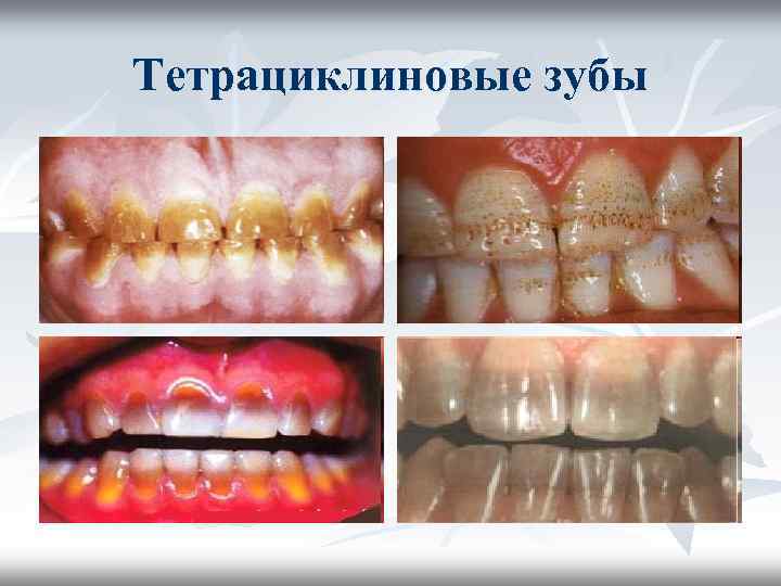Тетрациклиновые зубы Тетрациклиновые зубы