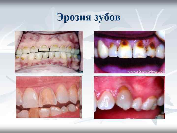 Эрозия зубов Эрозия зубов