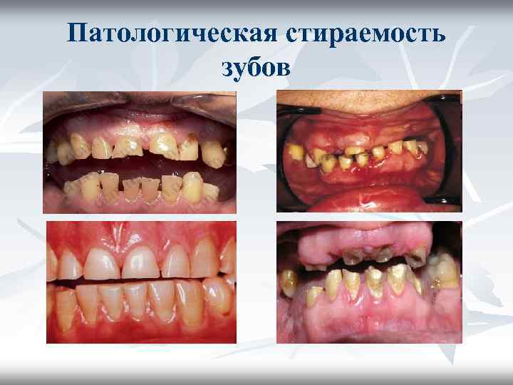 Патологическая стираемость зубов Патологическая стираемость зубов