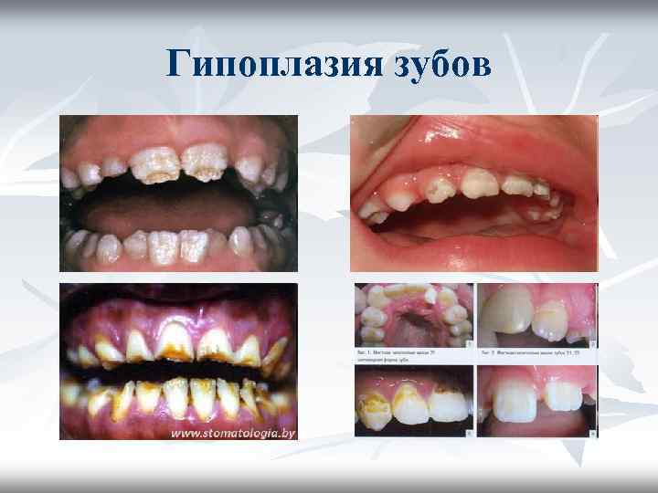 Гипоплазия зубов Гипоплазия зубов